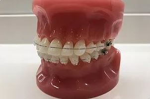 Ortodoncia estética