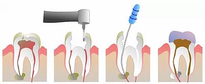 endodoncia endodoncia Clínica dental en Madrid