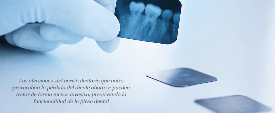 tratamiento dental endodoncia