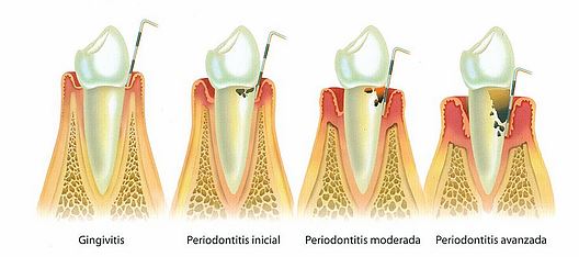 Periodoncia Clínica dental en Madrid