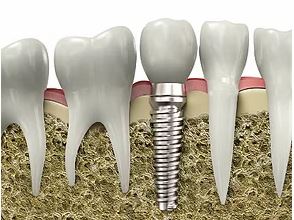 Implantes dentales Clínica dental en Madrid