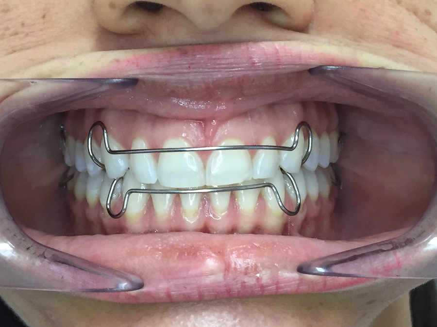 mínimo Repegar Descarte retenedor de ortodoncia archivos - Atauri & Cano Dental