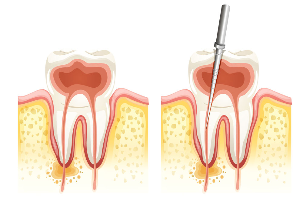 ¿Cuándo se hace una endodoncia?