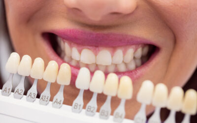 Consejos para cuidar las carillas dentales