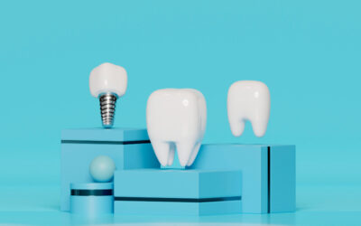 Cronograma de un tratamiento con implantes dentales